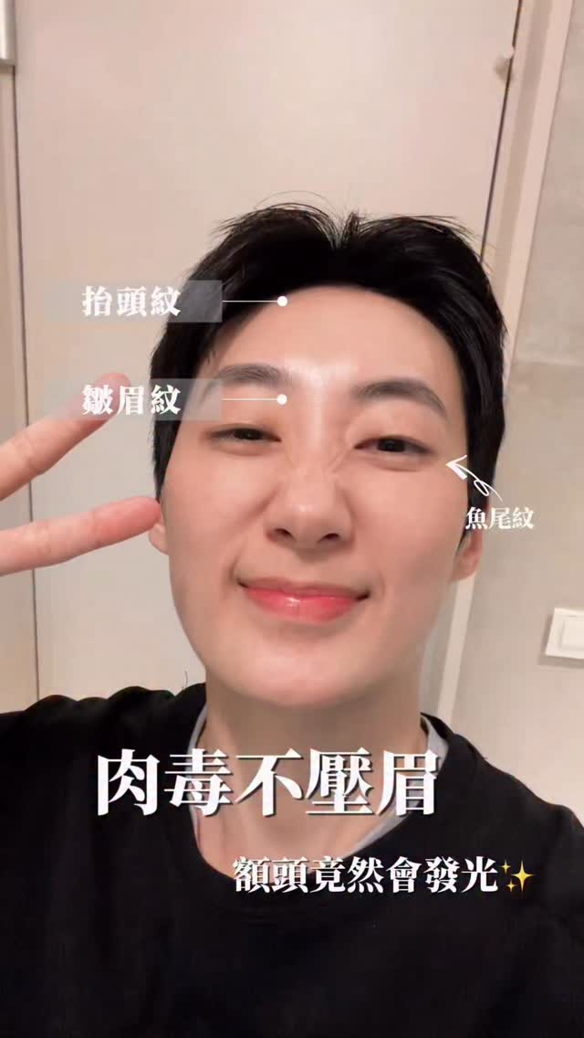 肉毒除皺三區AFTER