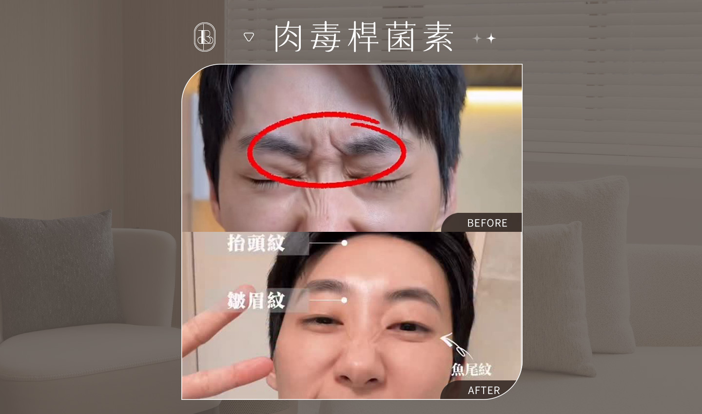 肉毒除皺BA_抬頭紋、皺眉紋、魚尾紋
