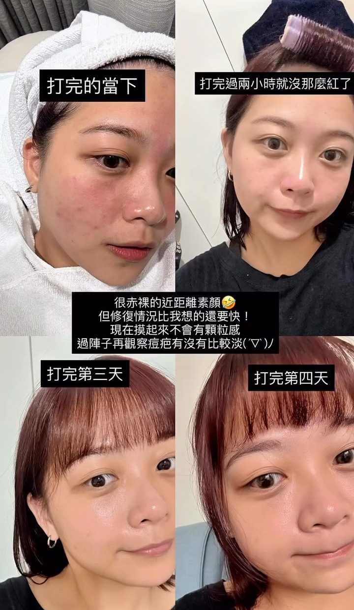 蜂巢皮秒雷射術後皮膚狀況追蹤