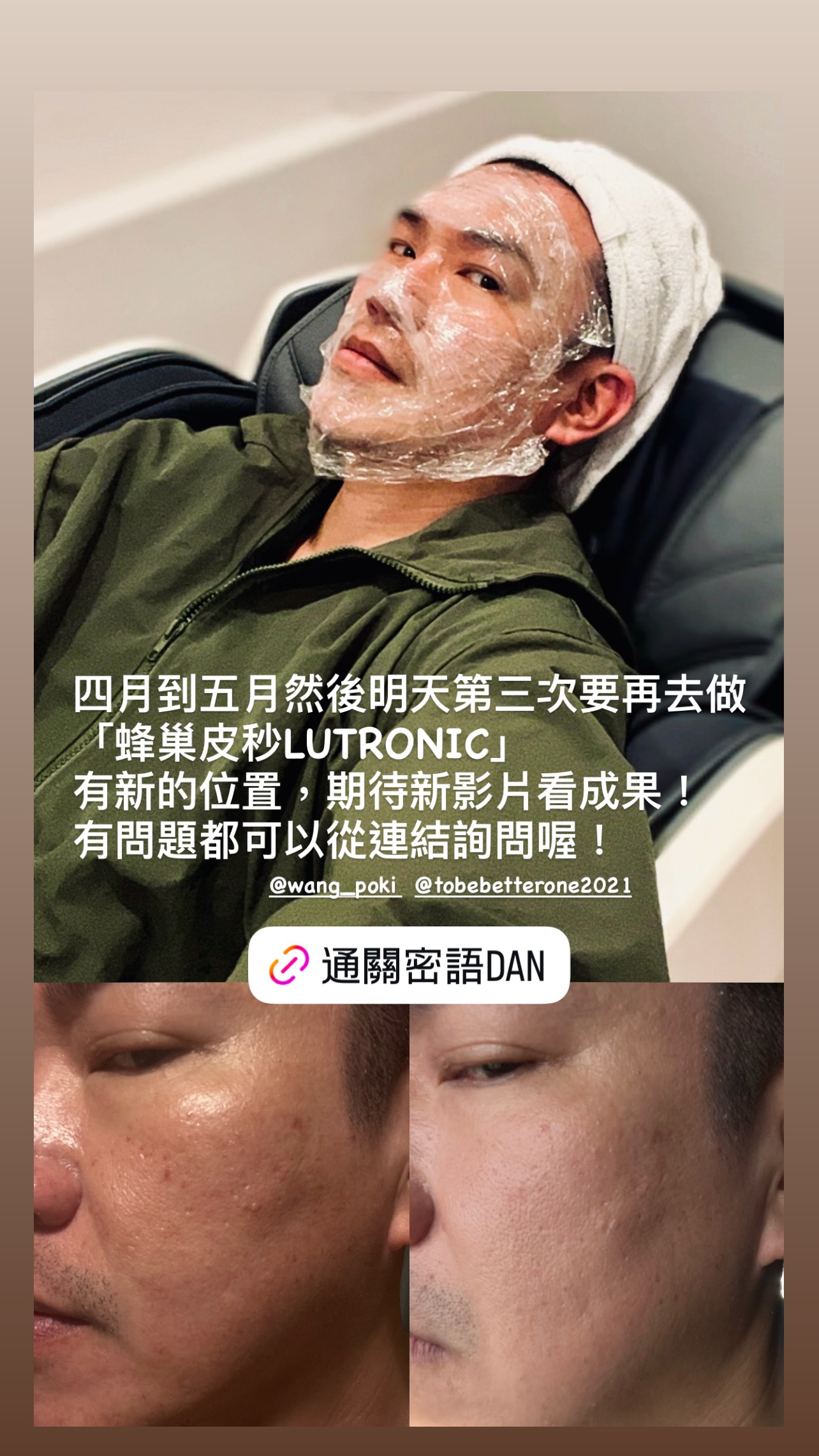 KOL阿丹-第二次BA