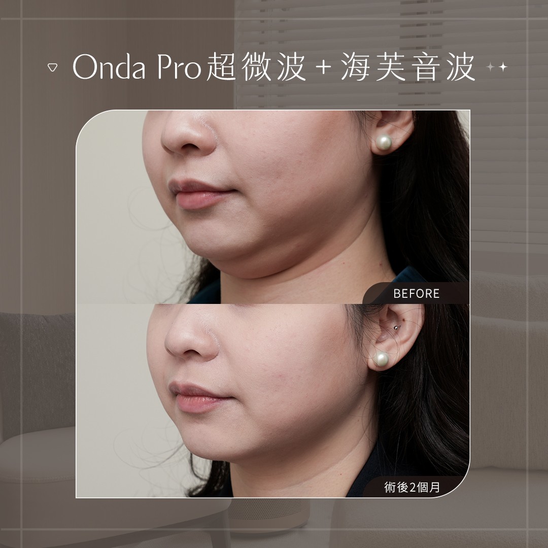 ONDA PRO＋第三代海芙音波 案例