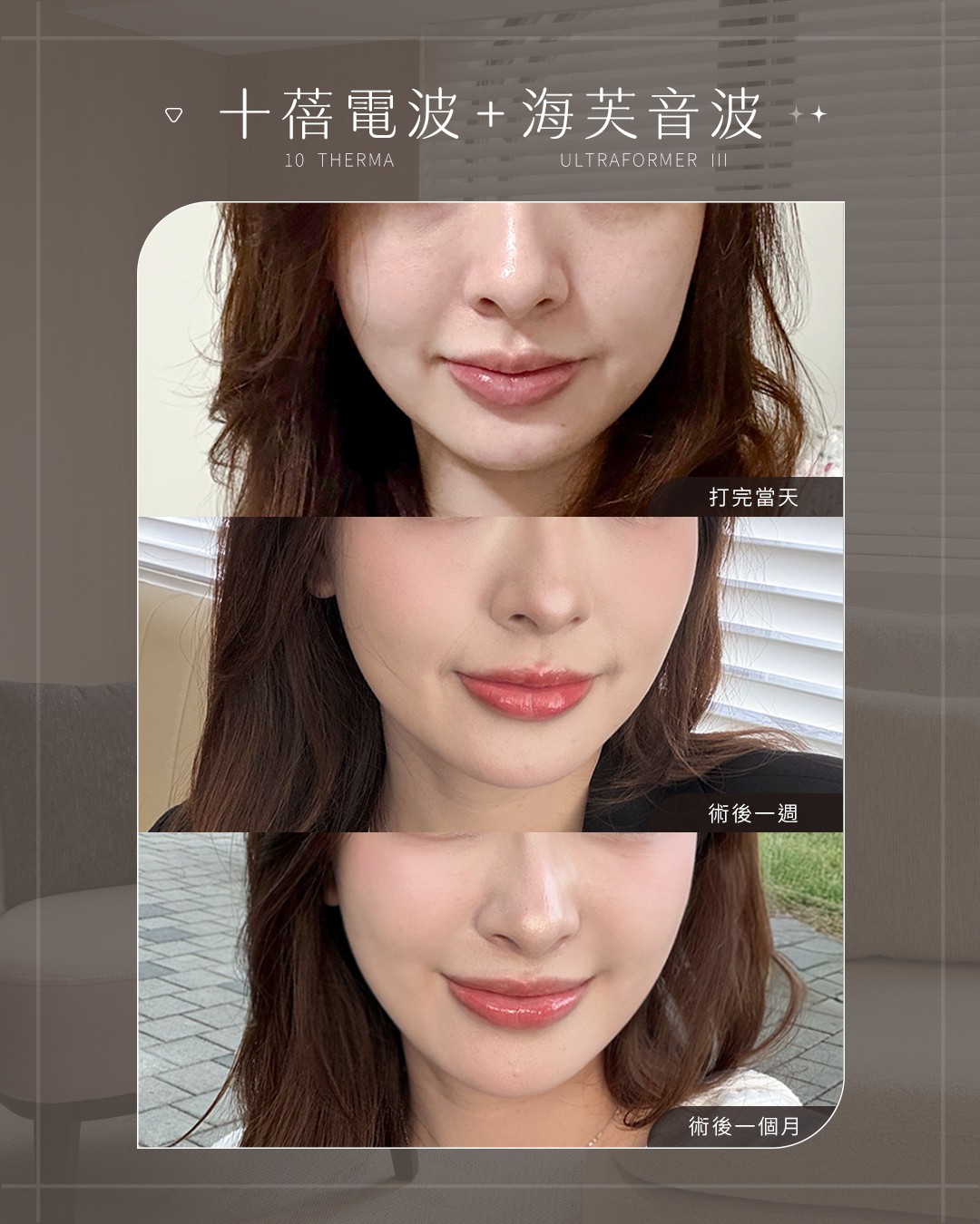 十蓓電波＋第三代海芙音波 案例