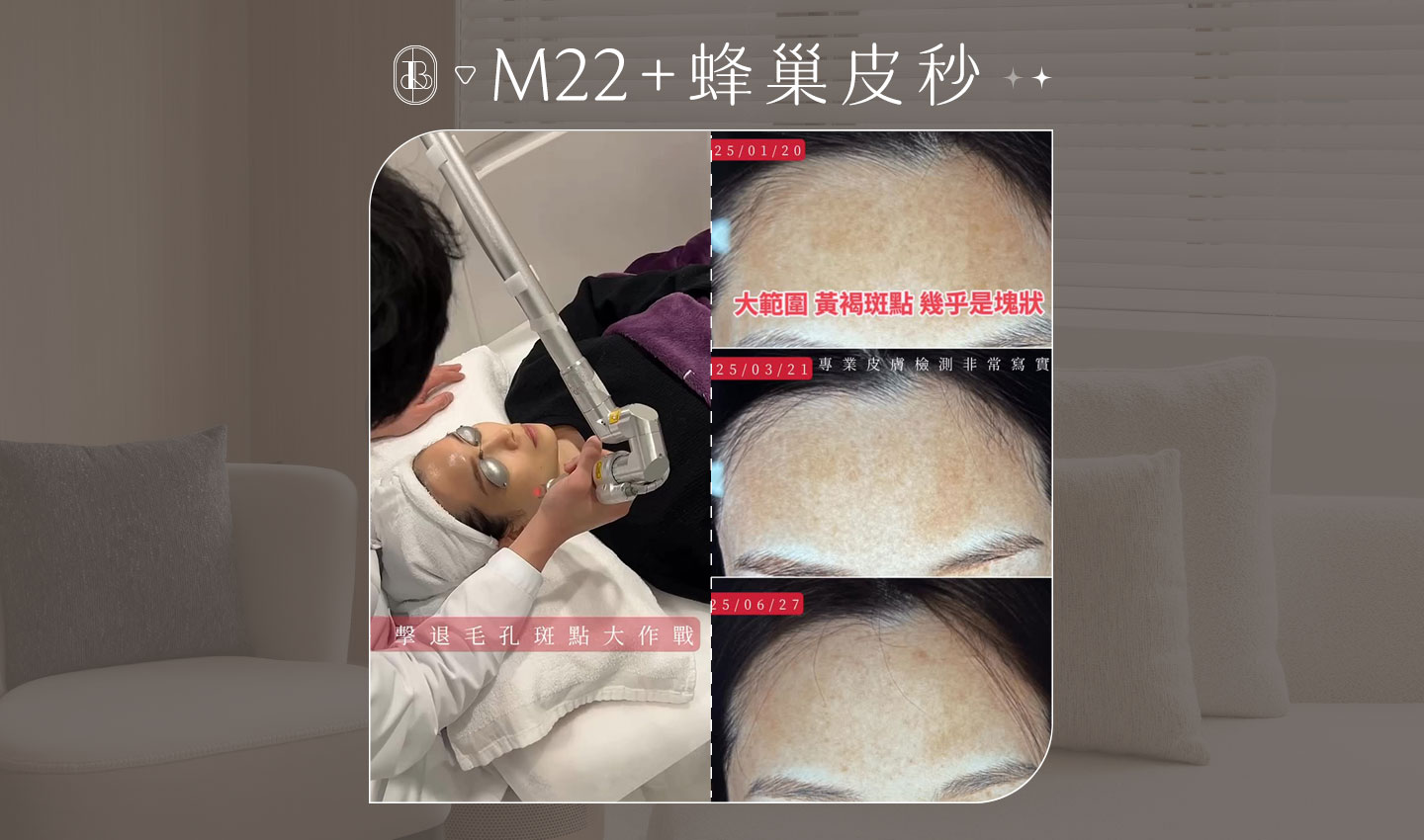 M22+蜂巢皮秒 KOL體驗心得