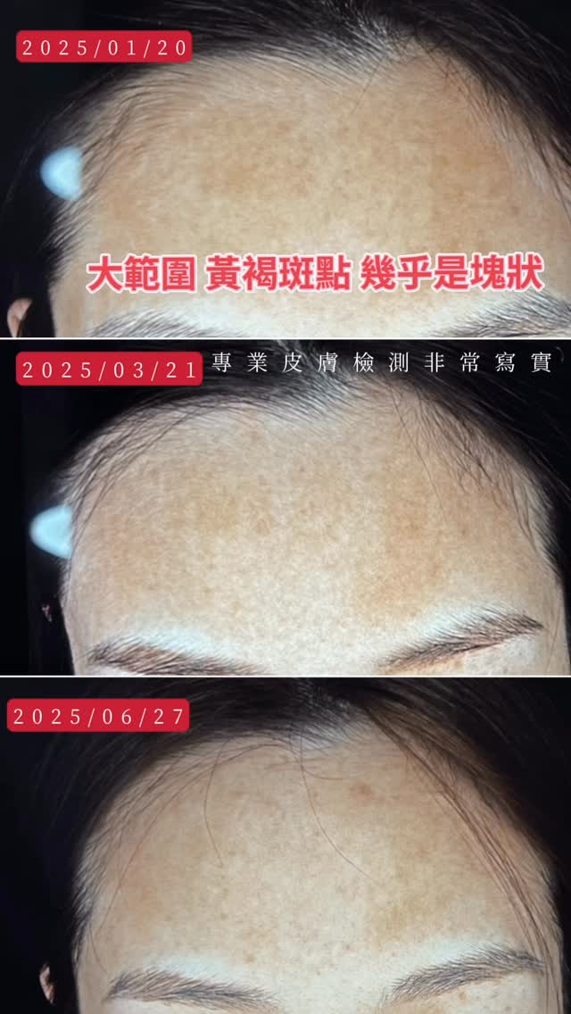 膚質分析儀下的皮膚改善變化