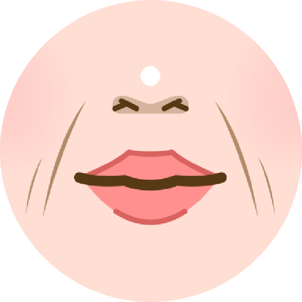 肌肉型法令紋：主要來自表情肌過度出力，常見於表情豐富的人，大笑時紋路特別明顯，向外放射