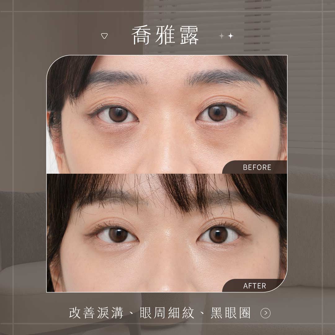 喬雅露BA_改善淚溝、眼周細紋、黑眼圈