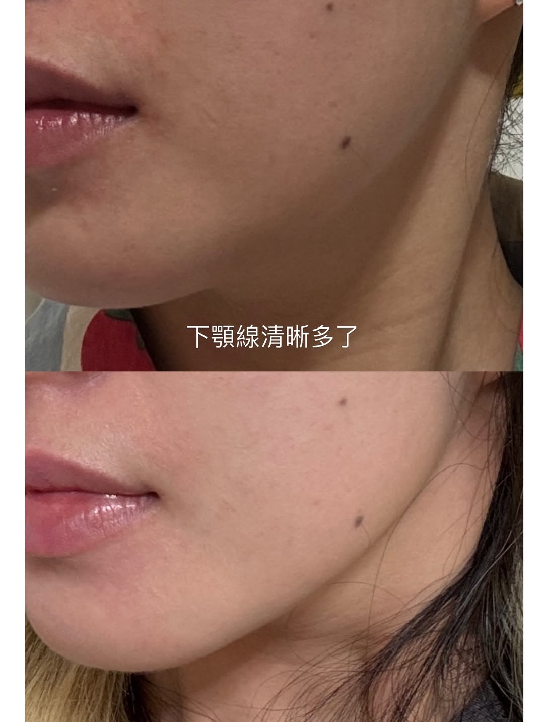 媚必提-AKA-下顎線BA