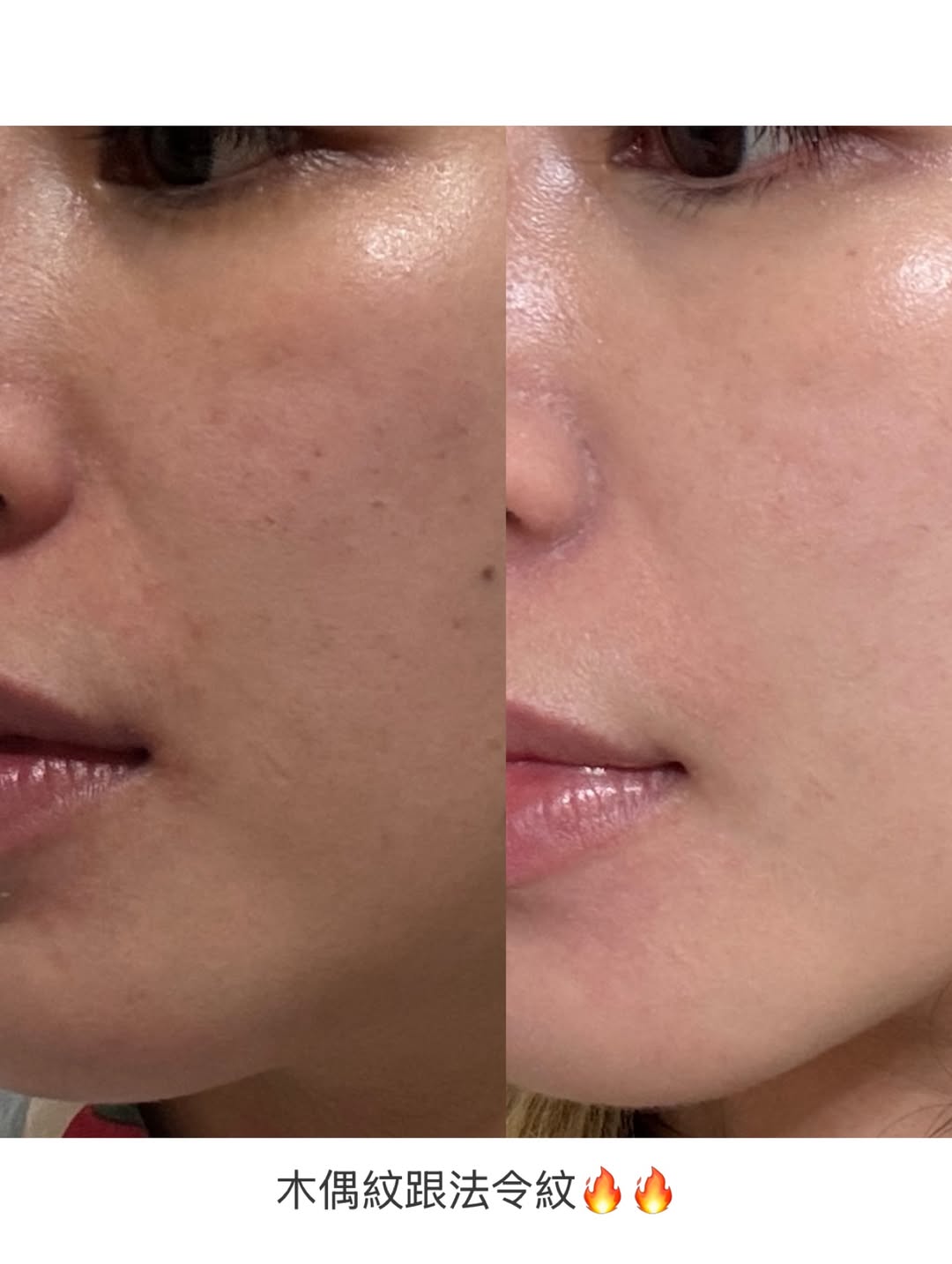 媚必提-AKA-木偶紋+法令紋BA