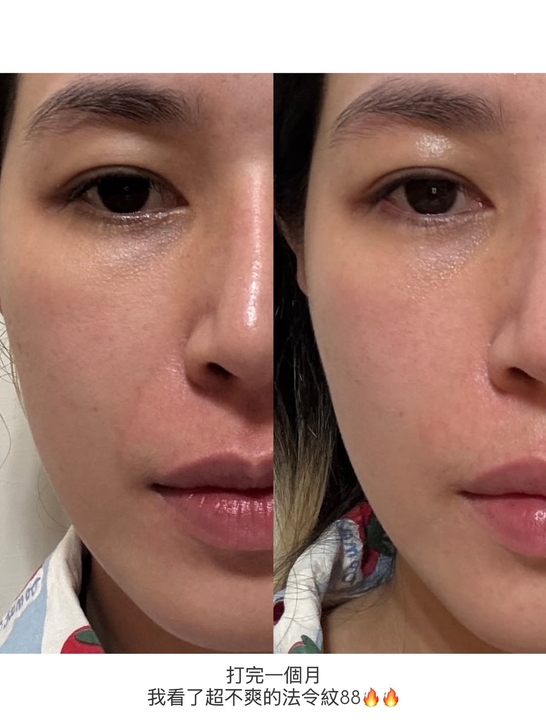 媚必提-AKA-法令紋BA