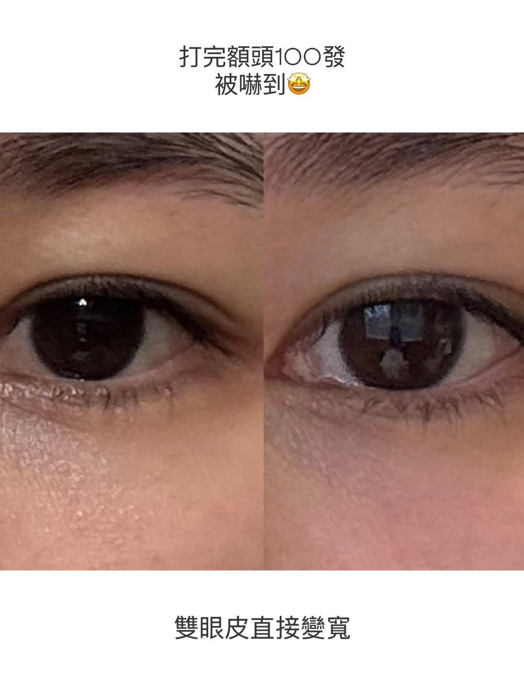 媚必提-AKA-眼周BA