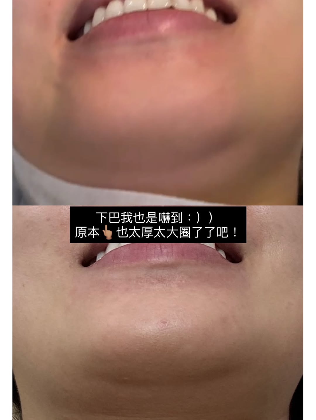 媚必提-AKA-雙下巴BA