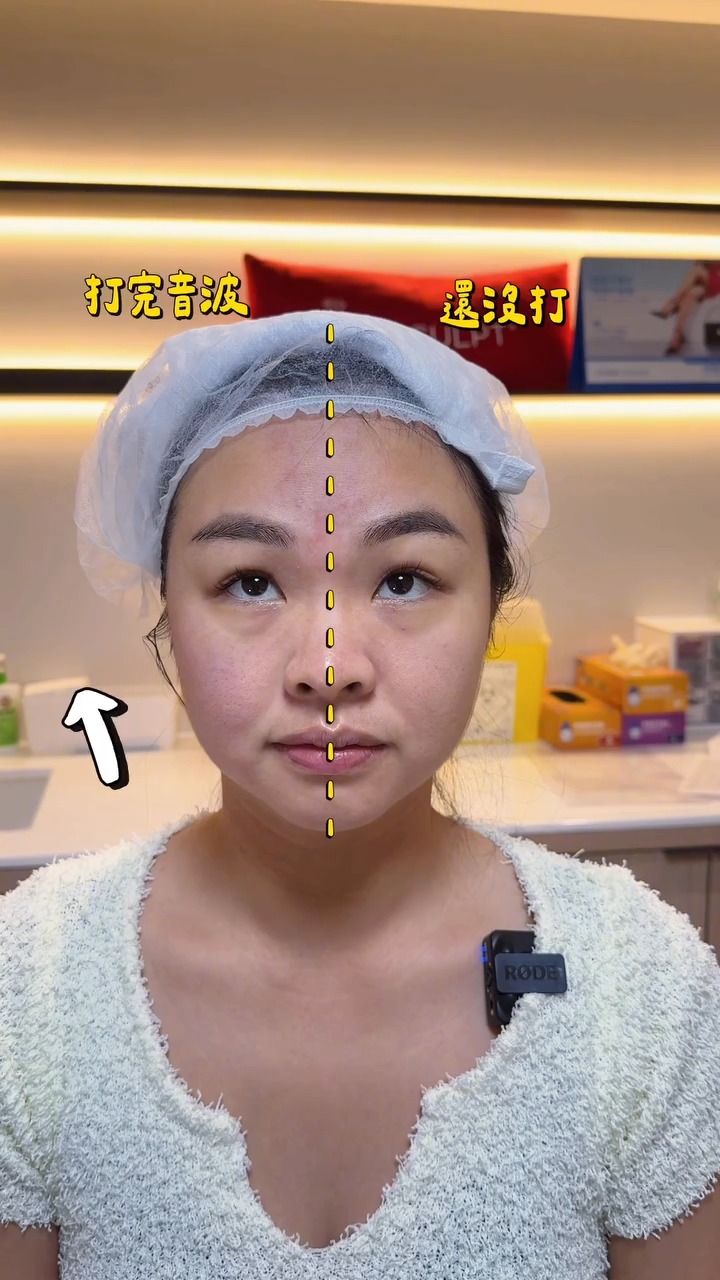 海芙音波-伊娃Eva-術中施作半臉效果