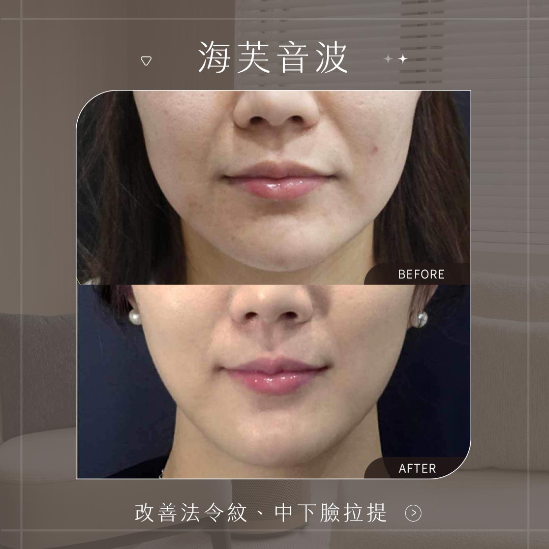 海芙音波BA 改善法令紋、中下臉拉提