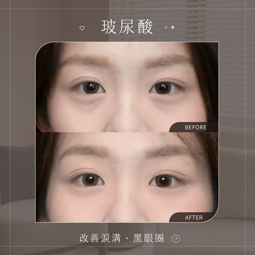 玻尿酸BA_改善淚溝、黑眼圈