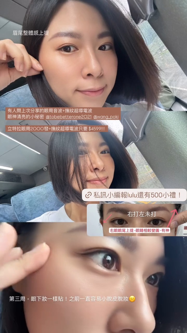 立特拉音波-Lulu 施打心得眼周上提