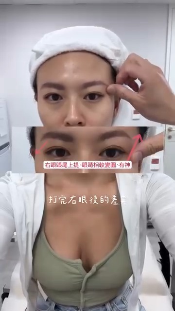 立特拉音波-Lulu 施打當下眼尾上提、有神