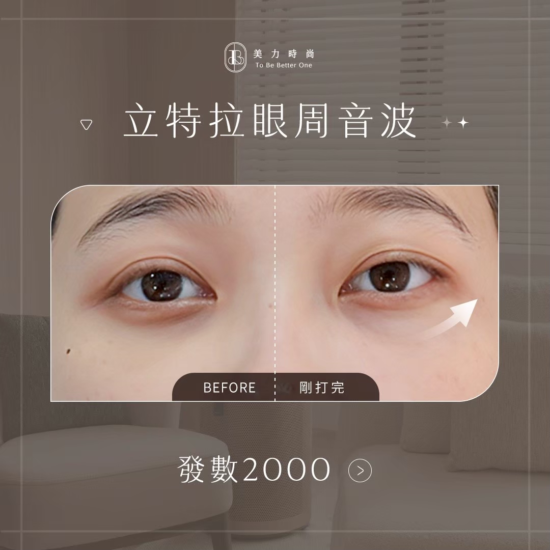 立特拉音波｜眼周BA