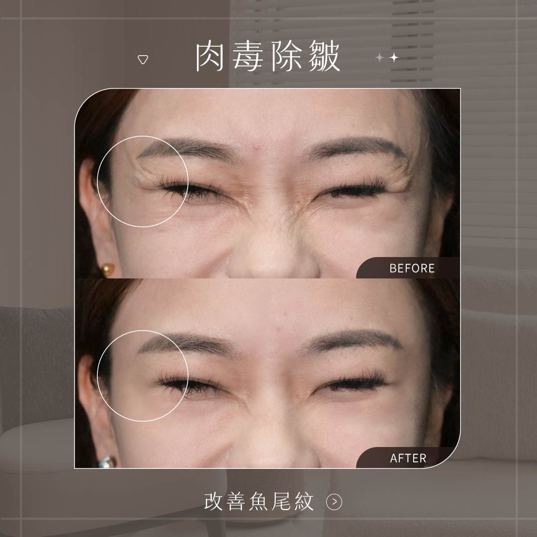 肉毒除皺BA_改善魚尾紋
