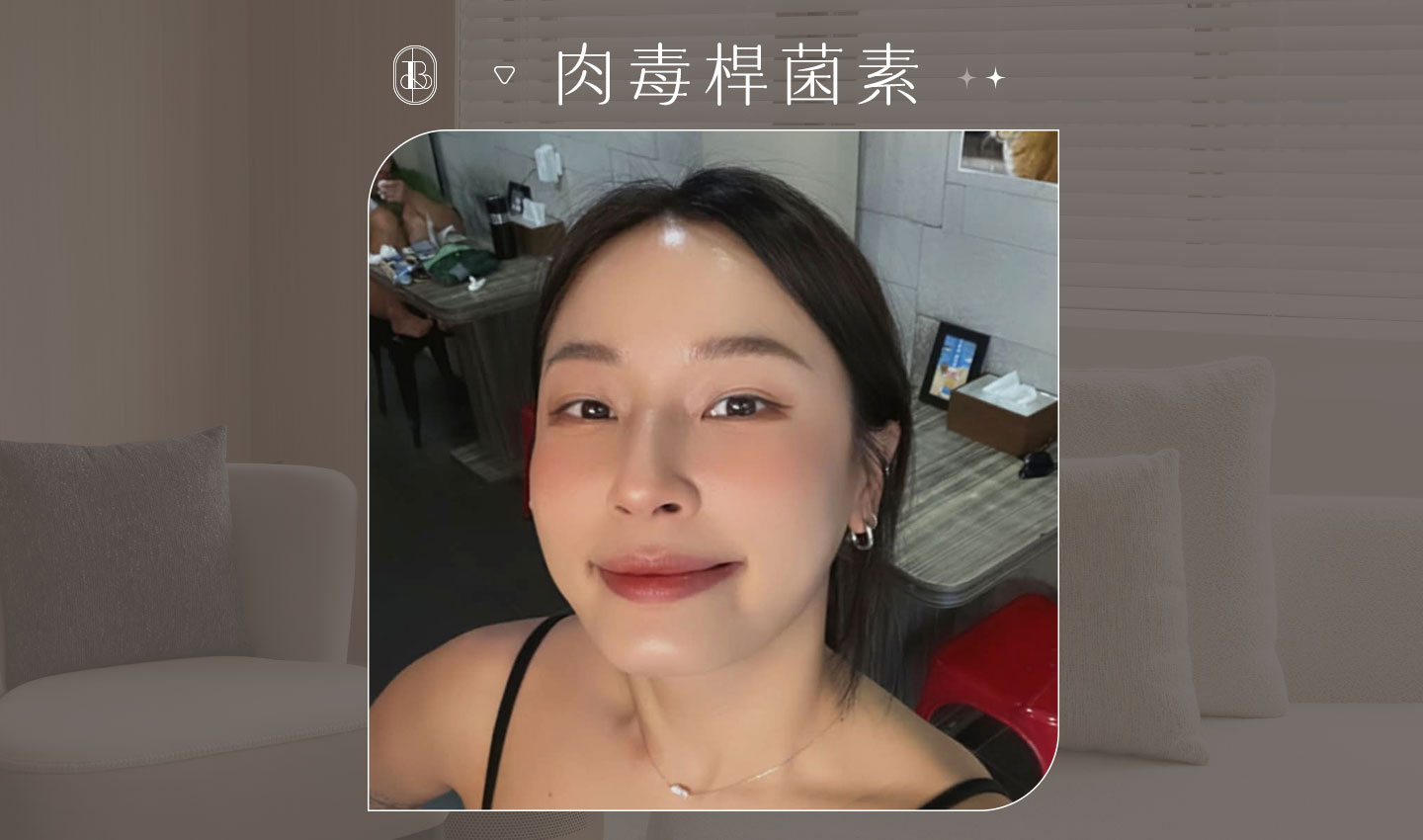 肉毒除皺(抬頭紋)-Kellybon-BA