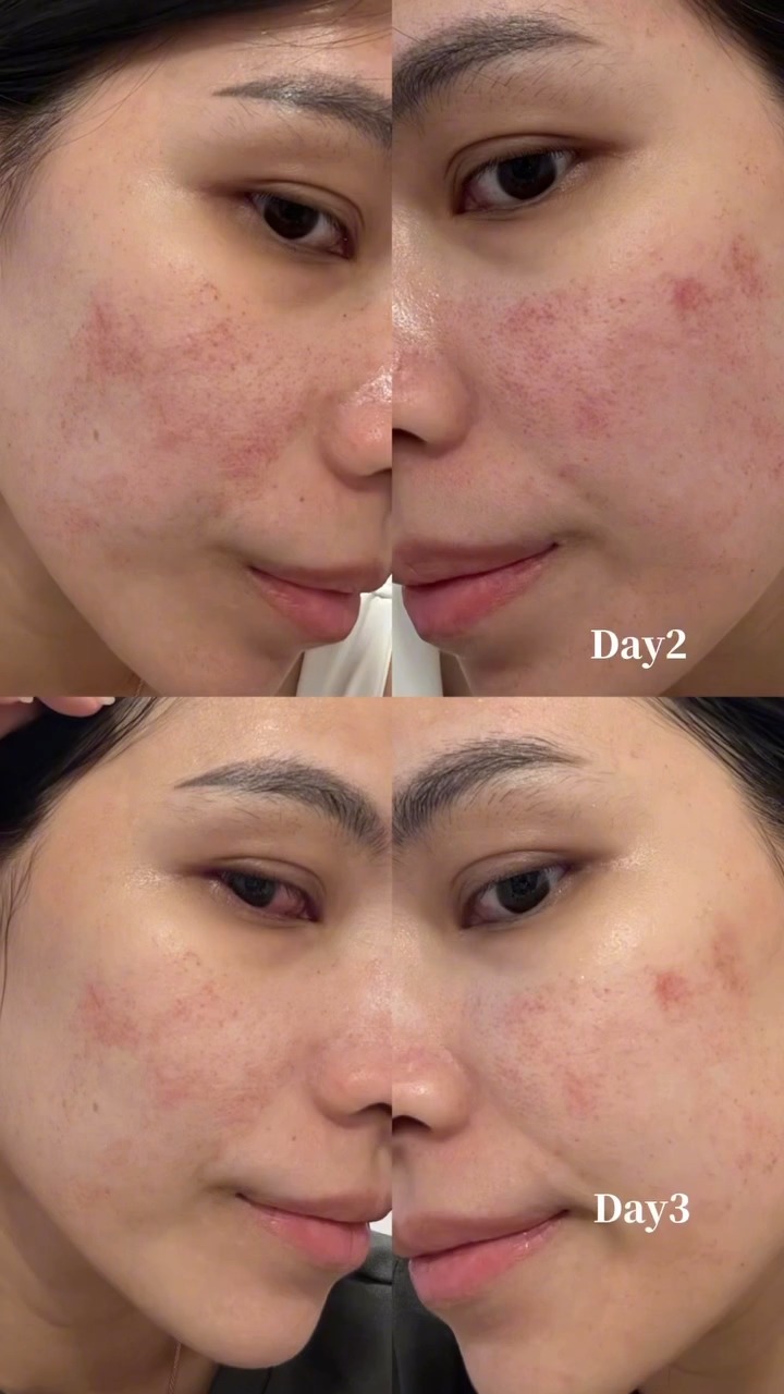 蜂巢皮秒-琳恩-術前+術後2天皮膚變化