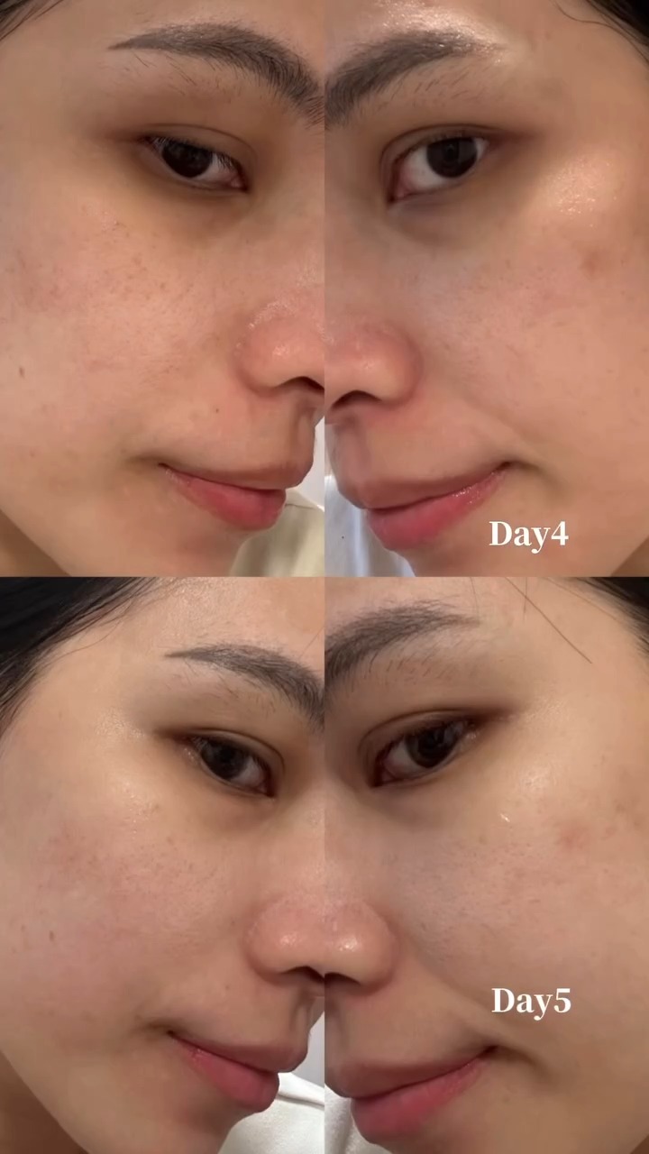 蜂巢皮秒-琳恩-術後4-5天皮膚變化