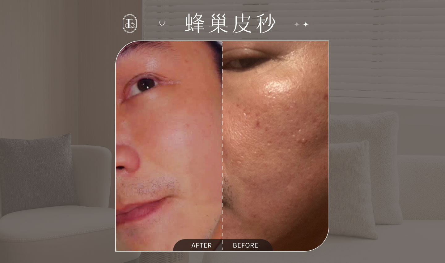 蜂巢皮秒-阿丹BA