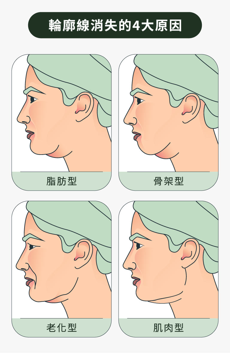 輪廓線消失的4大原因