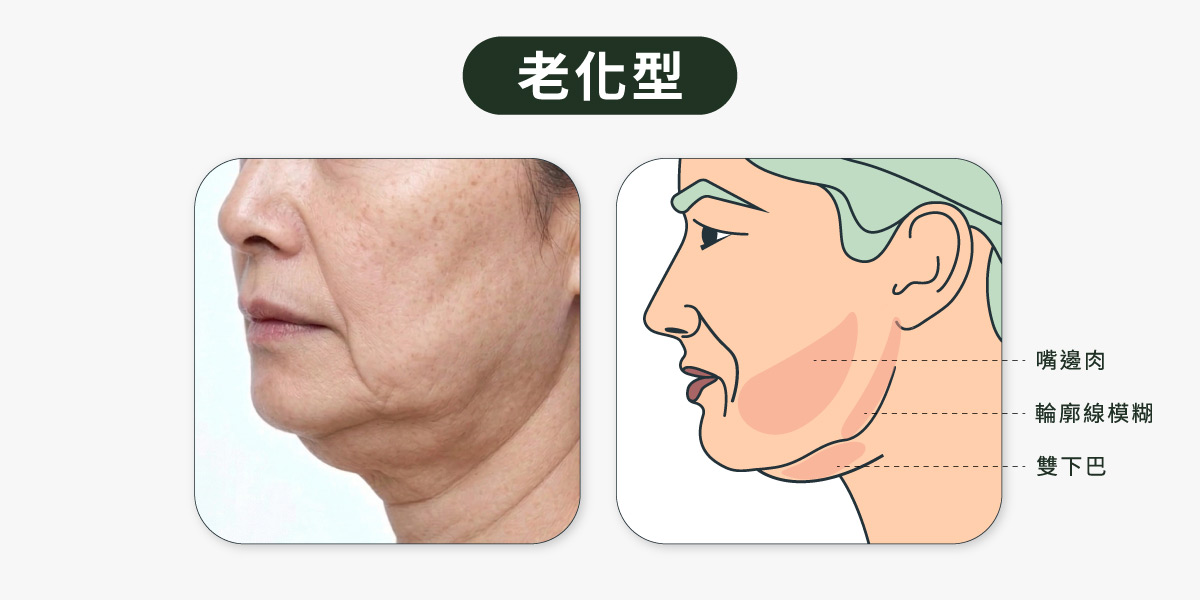 輪廓線消失_老化型雙下巴