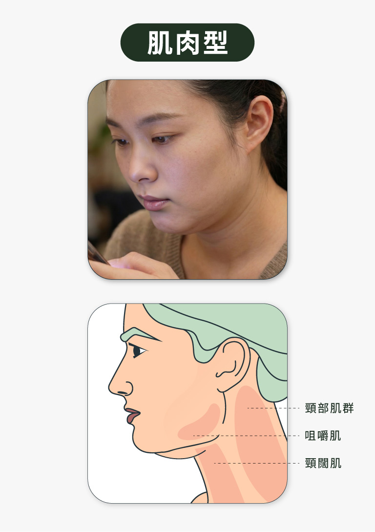 輪廓線消失_肌肉型雙下巴