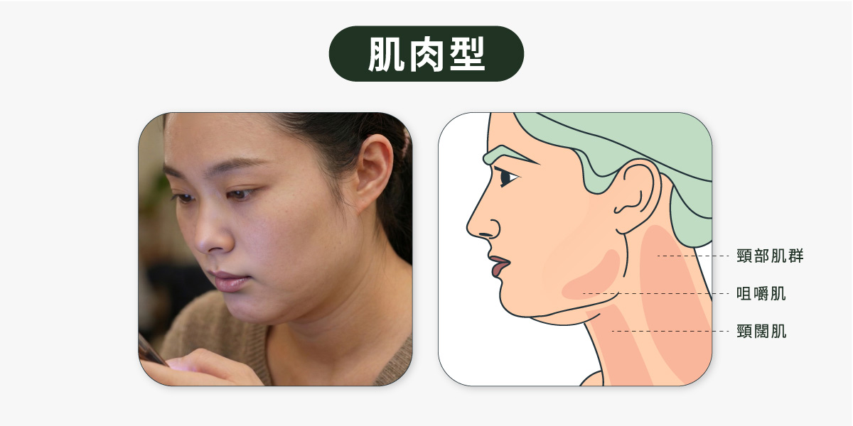 輪廓線消失_肌肉型雙下巴