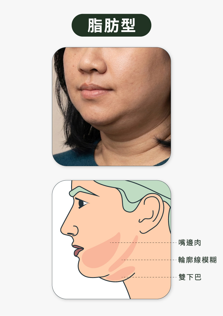 輪廓線消失_脂肪型雙下巴