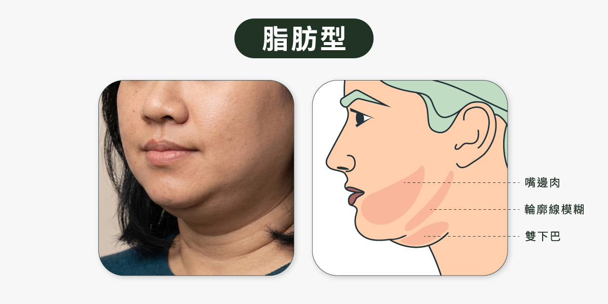 輪廓線消失_脂肪型雙下巴