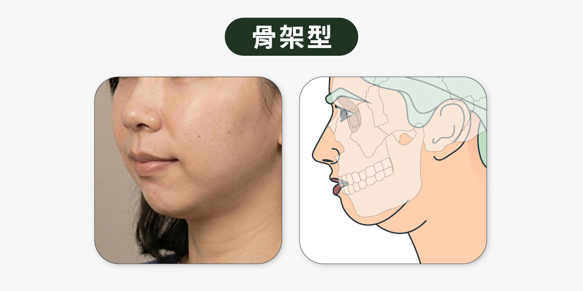 輪廓線消失_骨架型雙下巴