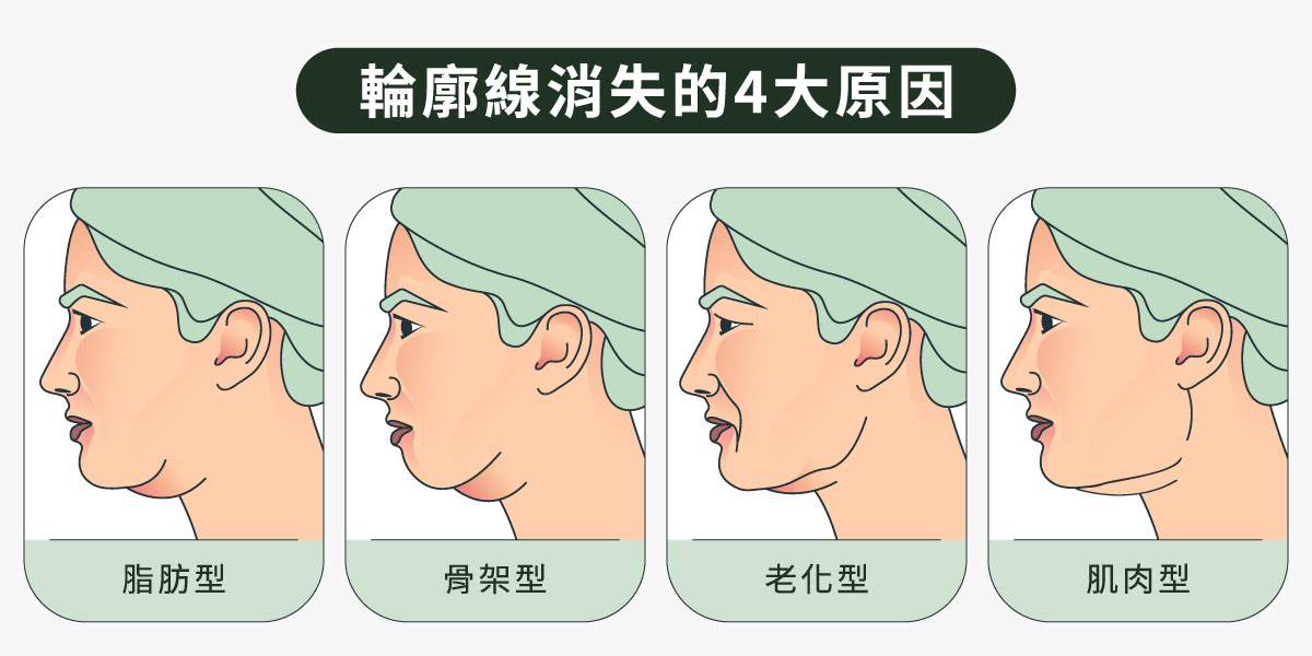 輪廓線消失的4大原因
