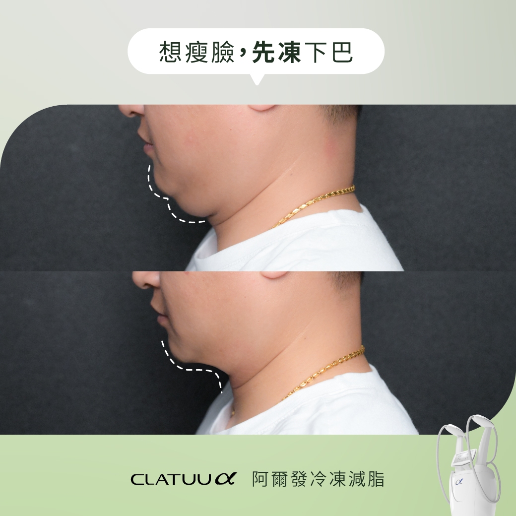 阿爾發冷凍減脂_雙下巴BA