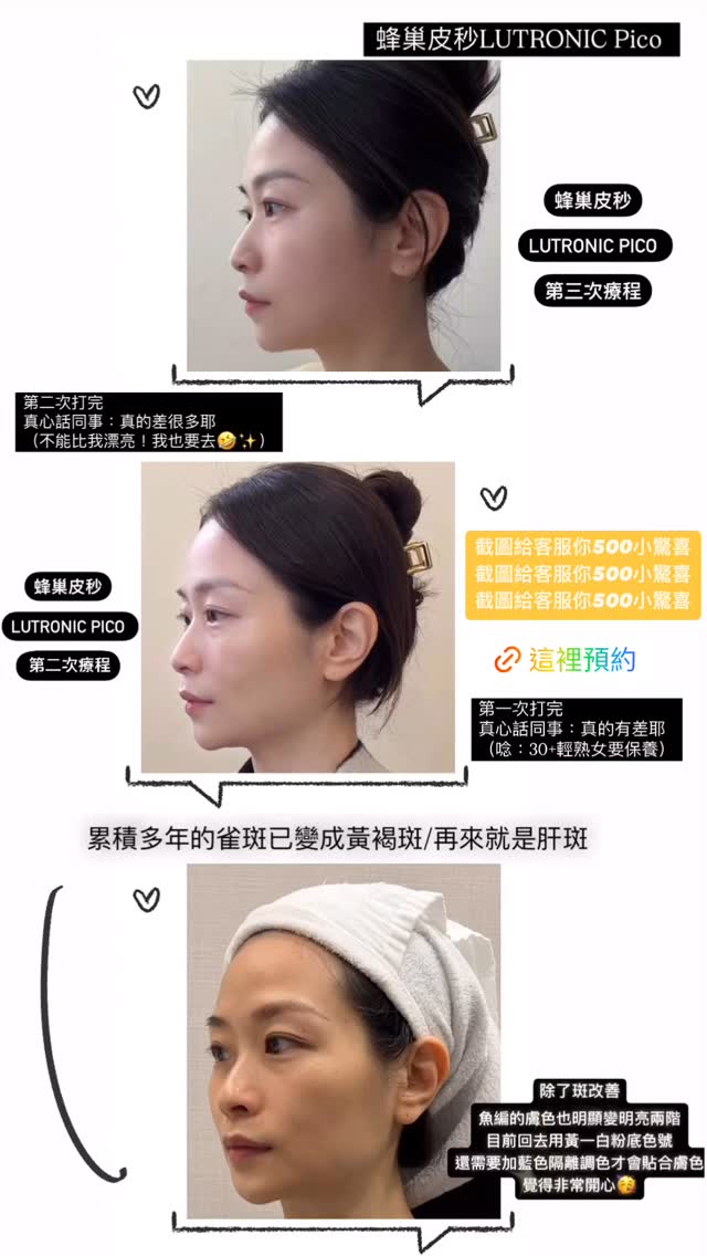 施作雙皮秒的皮膚改善變化