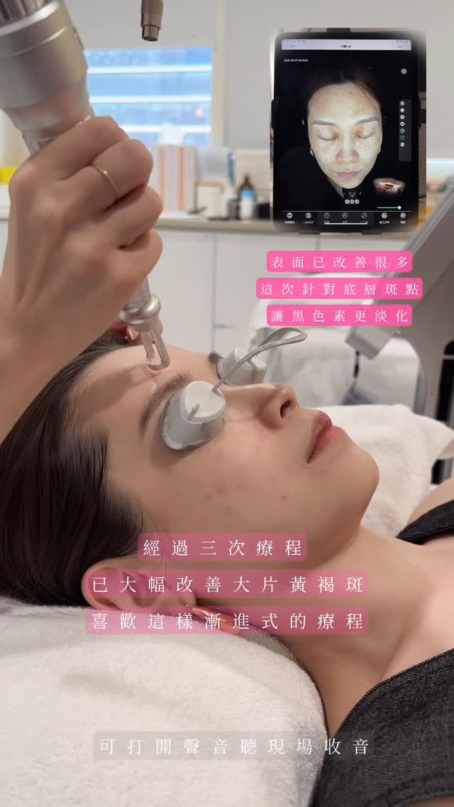 M22+皮秒療程三次療程後的心得