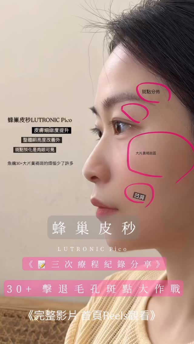 皮膚狀況 黃褐斑點、膚色不均、凹洞