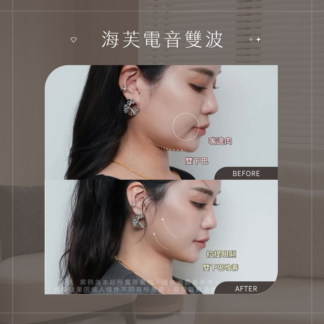 海芙電音雙波BA