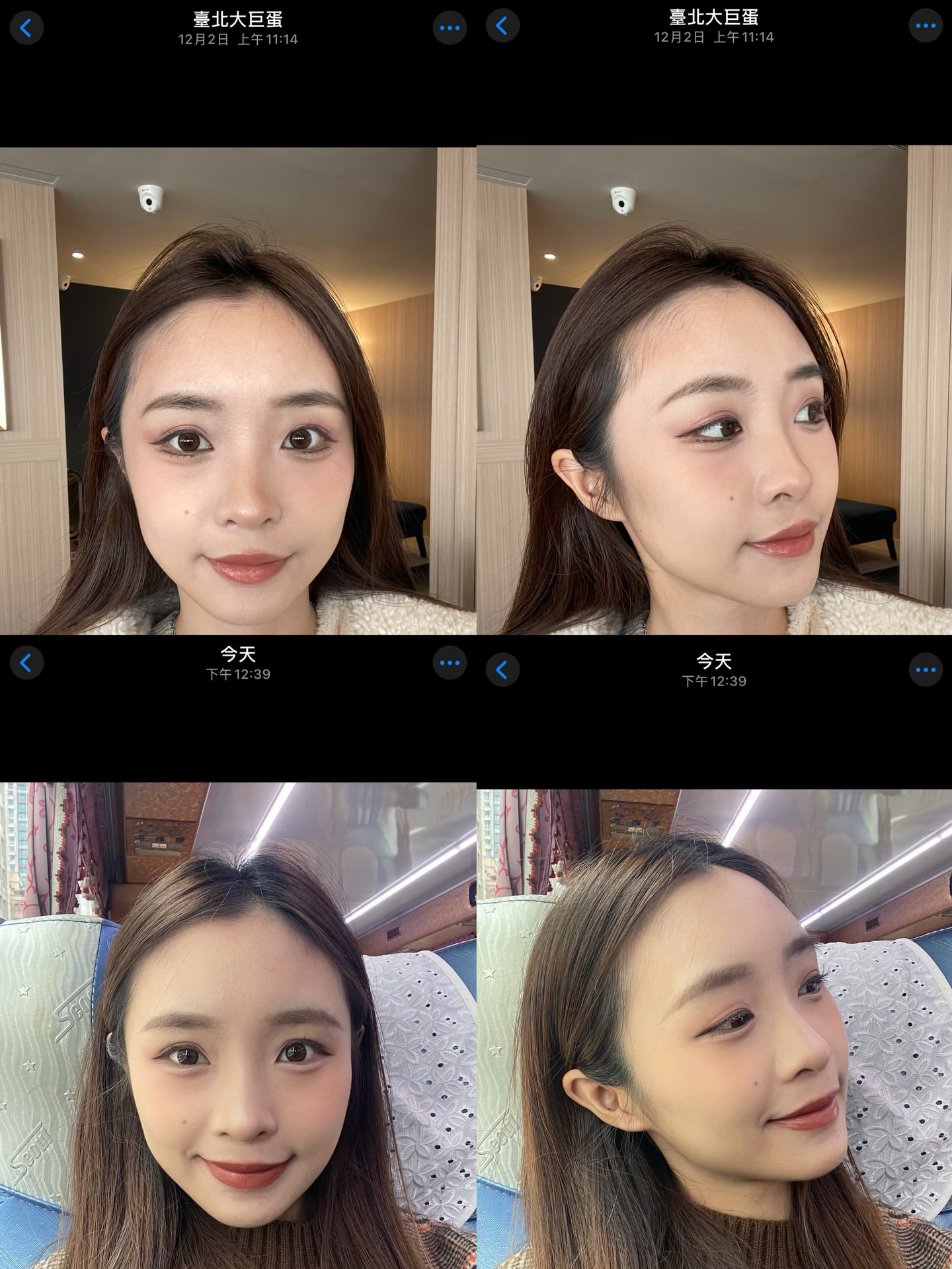 阿慈透過施打奇蹟肉毒改善咀嚼肌