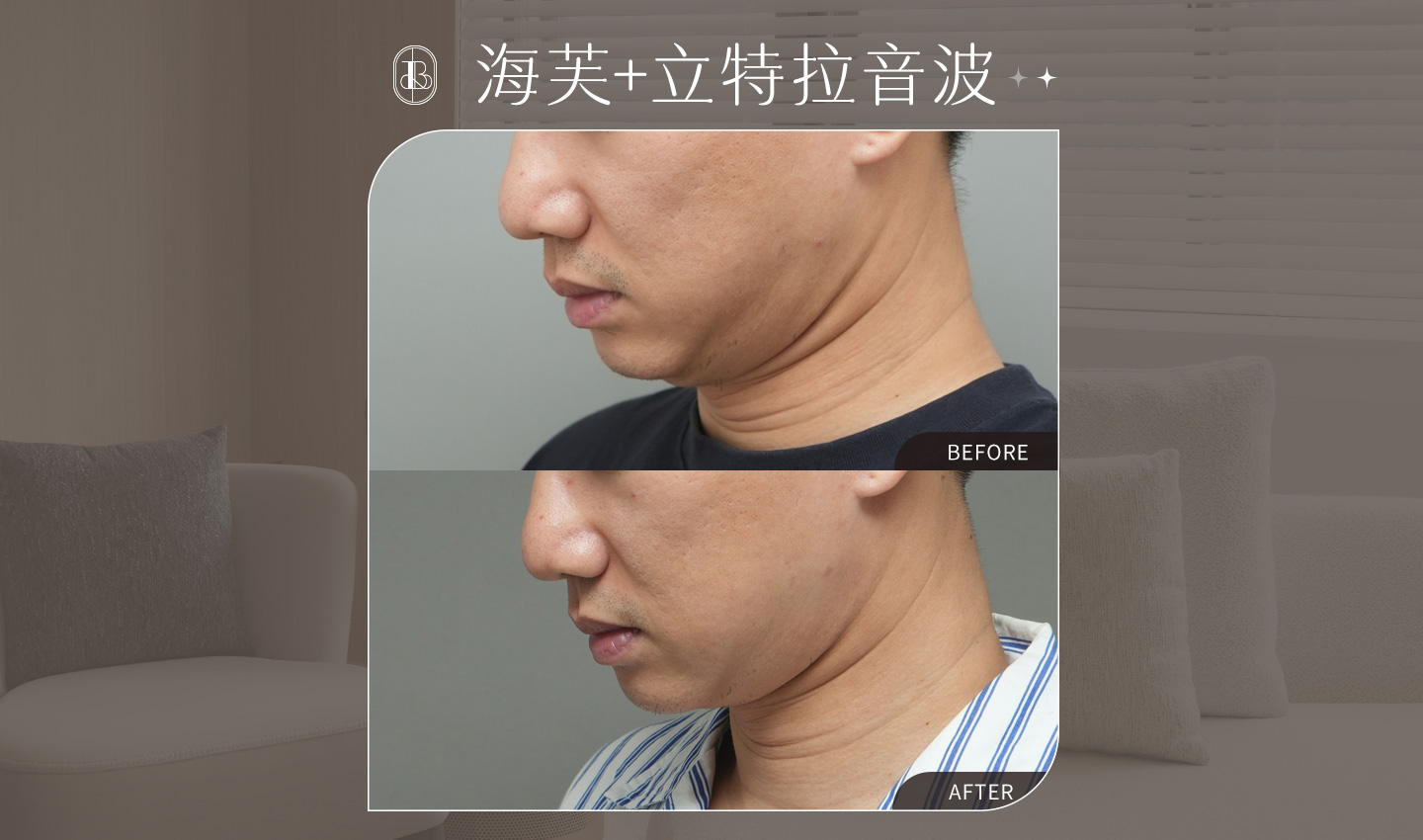 韓國音波雙機-王皓宇-封面圖-雙下巴改善有感