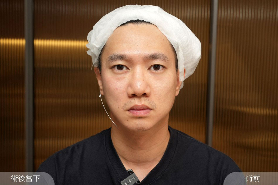 施打完韓國音波雙機半臉後臉部的立即變化