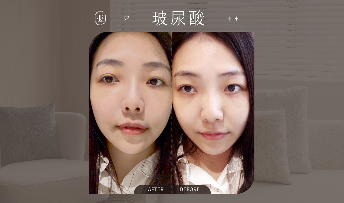 仙女玻尿酸-小日刀口-BA