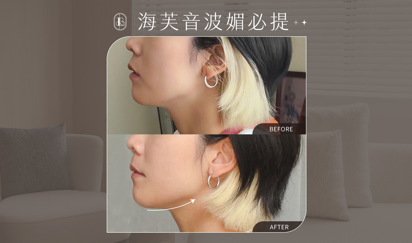 美力時尚診所案例：網紅《睡睡子》海芙媚必提心得分享~拯救雙下巴與眼周下垂，打造緊緻輪廓線！