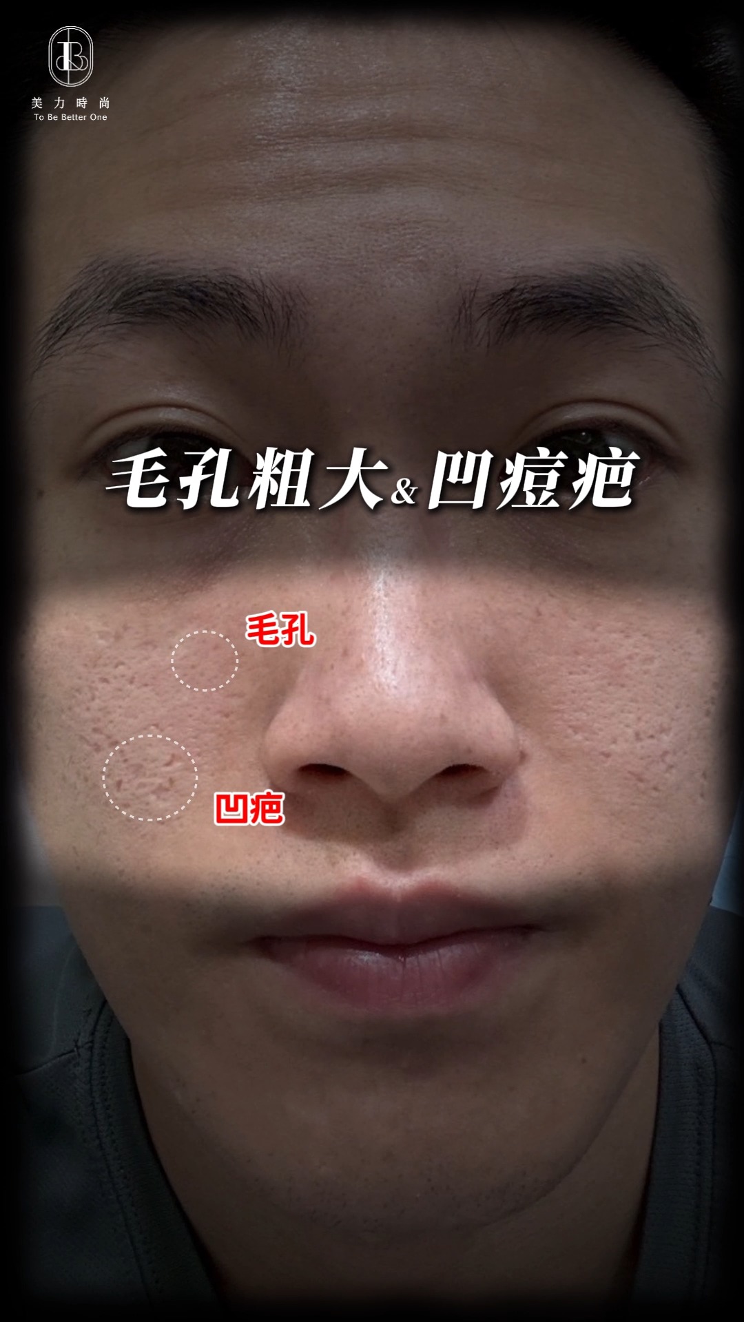 男性肌膚困擾：毛孔粗大、凹疤、痘痘疤