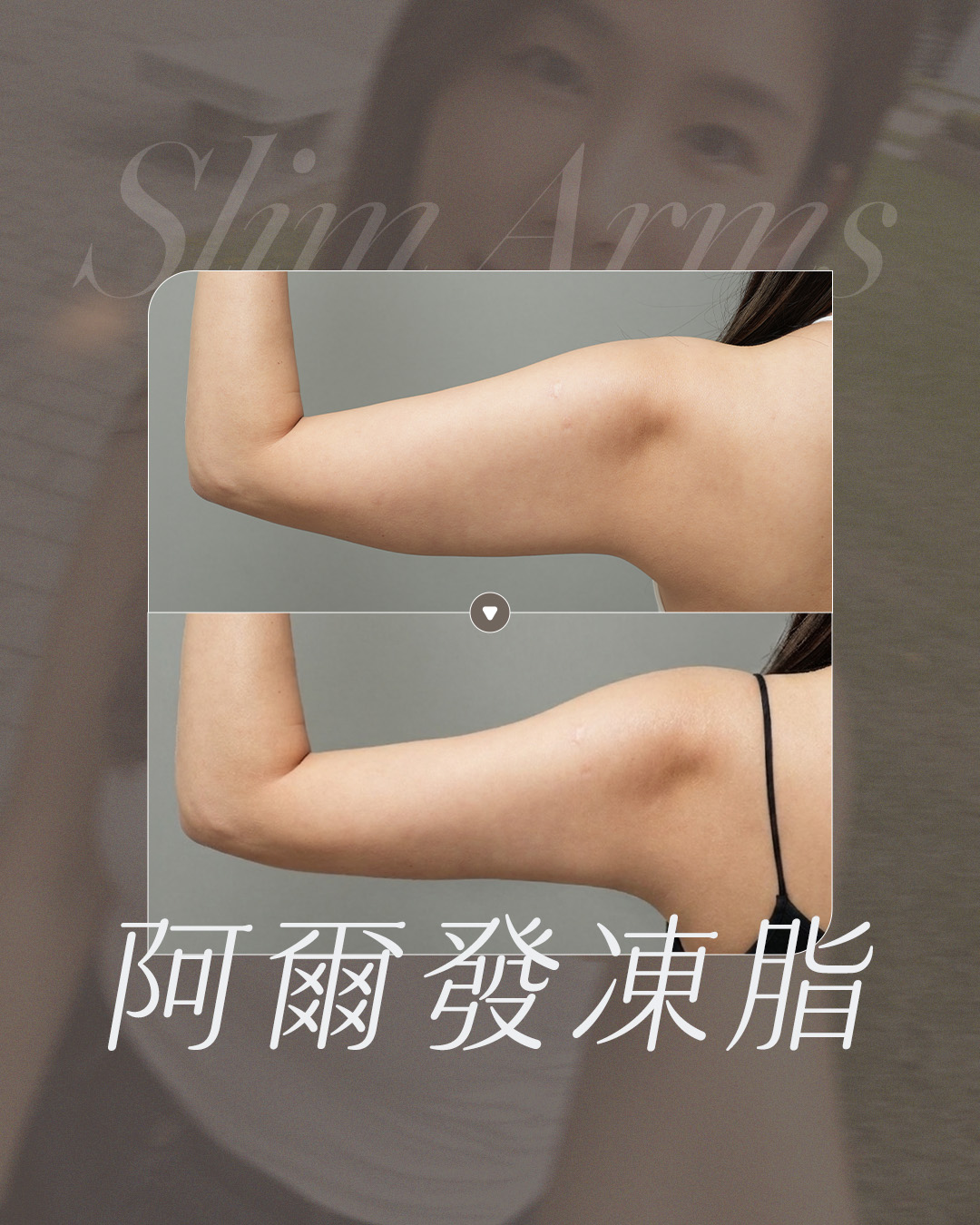 美力時尚診所冷凍減脂案例：阿爾發手臂BA