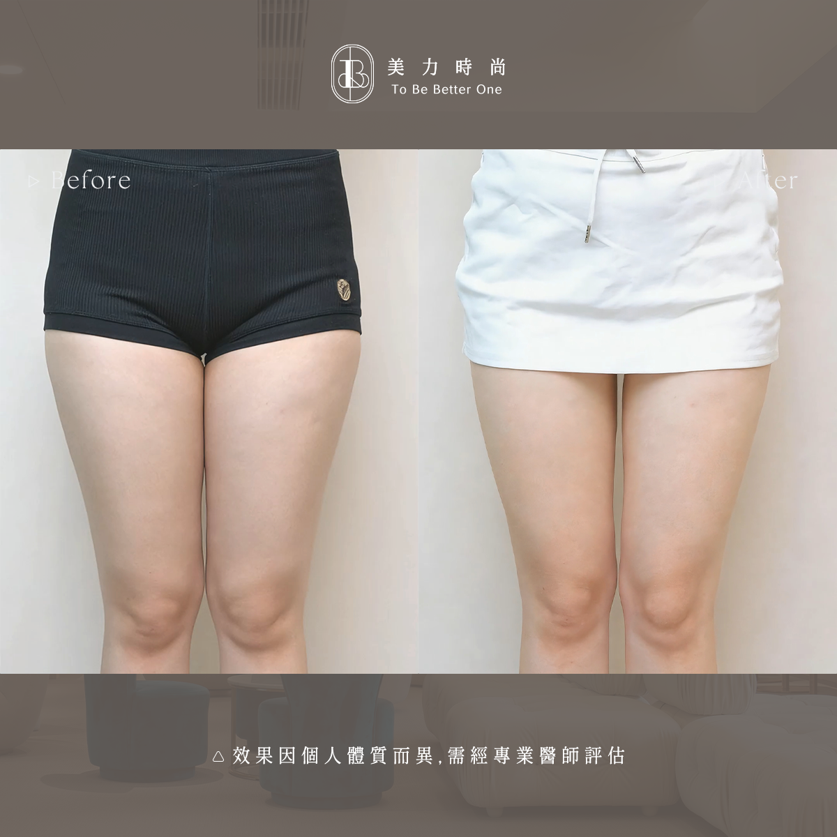 美力時尚診所冷凍減脂案例：大腿內側BA