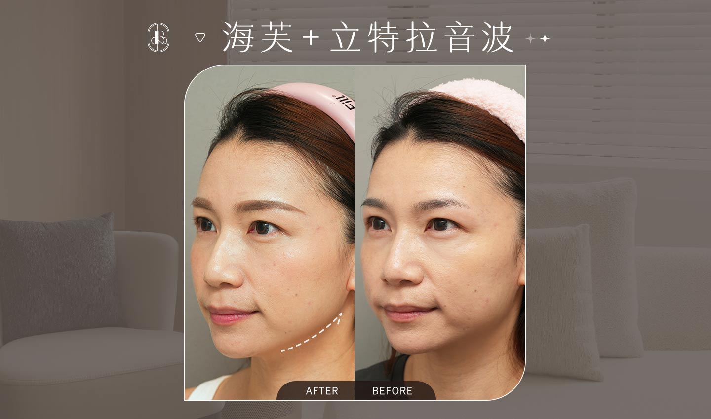 美力時尚診所案例：海芙音波+皇后音波BA