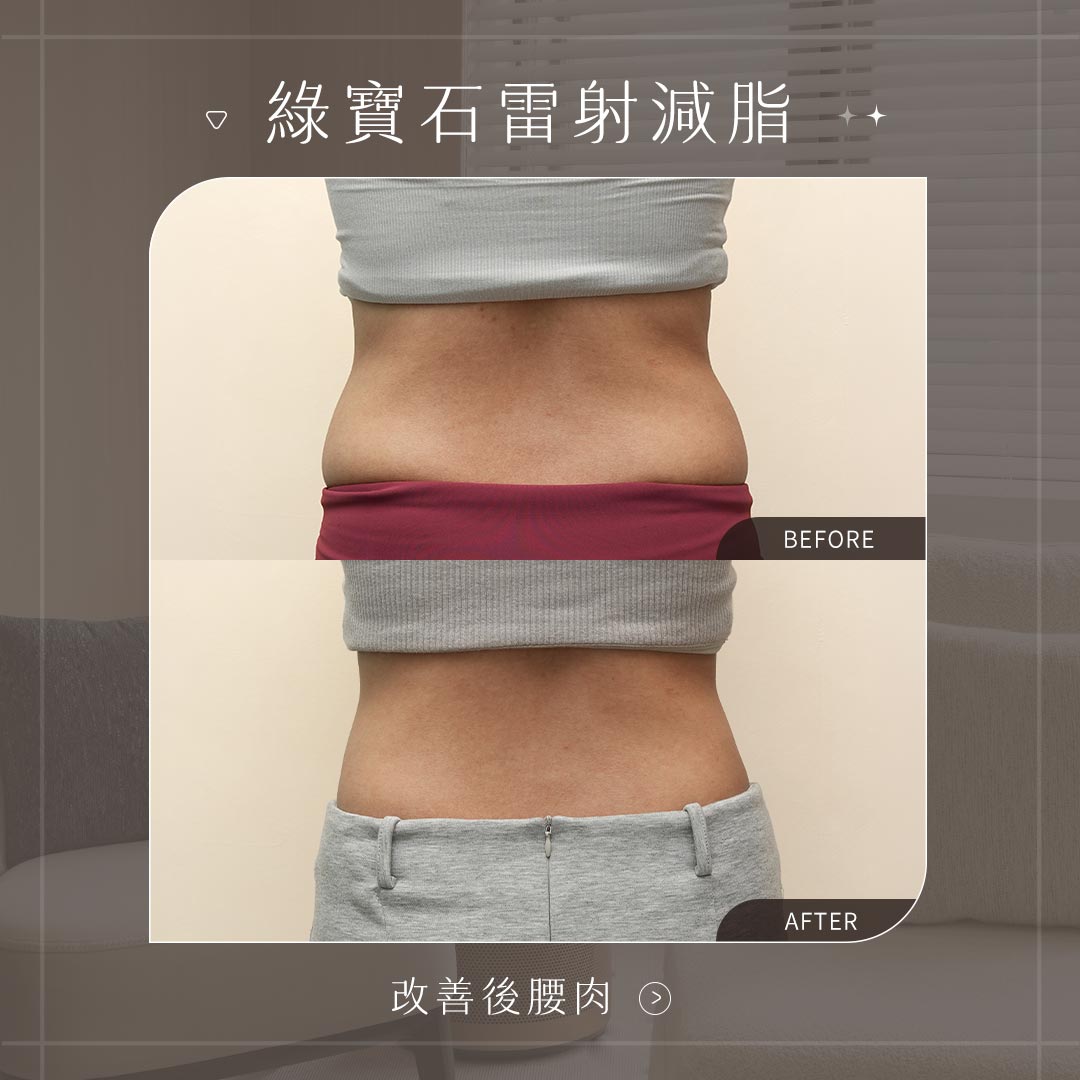 美力時尚診所 綠寶石減脂雷射案例：後腰肉BA