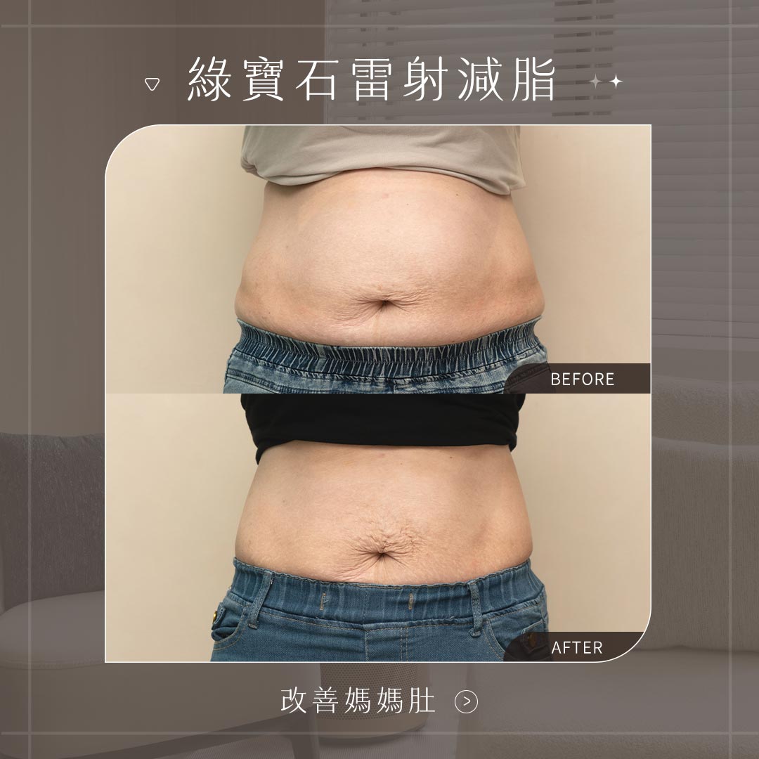 美力時尚診所 綠寶石減脂雷射案例：改善媽媽肚、有感減少腹圍